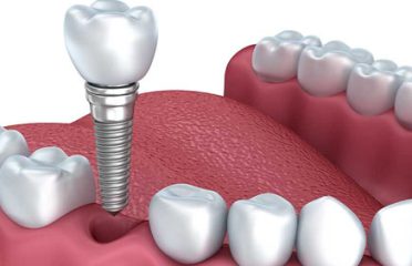 Dental Implants Perth